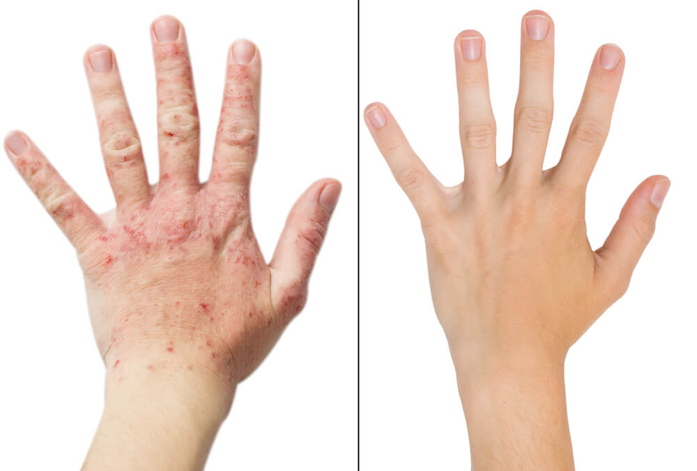 before and after eczema treatment