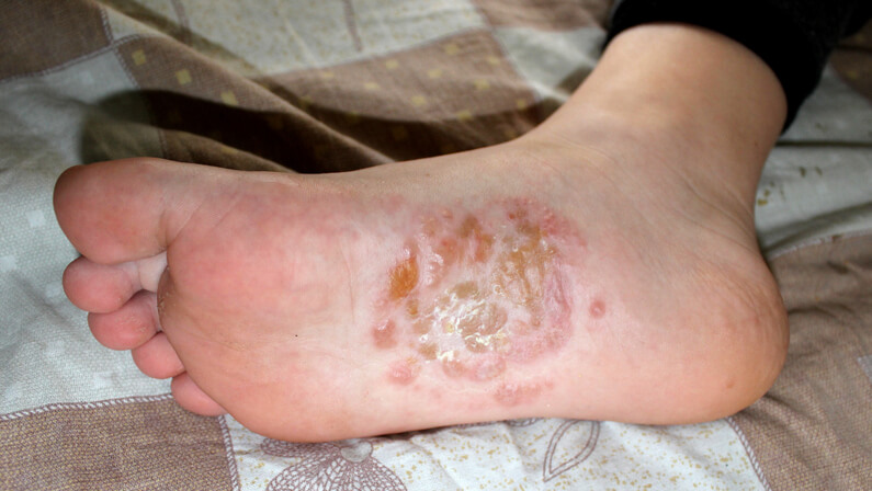 Dyshidrotic Eczema on a foot sole