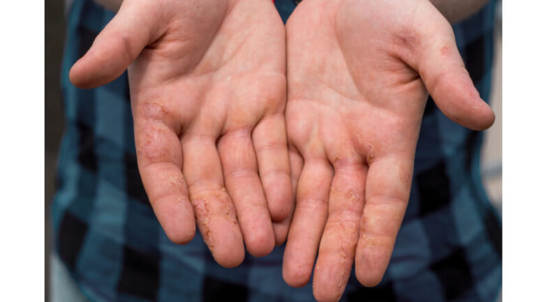 Dyshidrotic Eczema on a hands