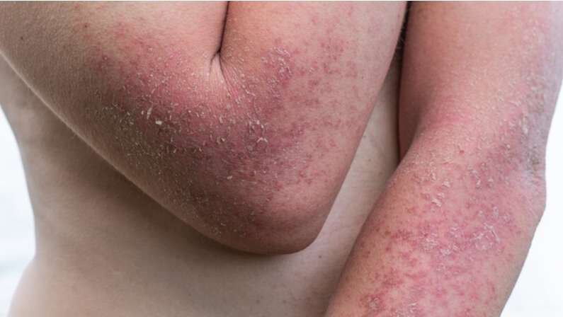 a person with Dyshidrotic Eczema