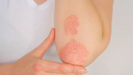 eczema on elbow