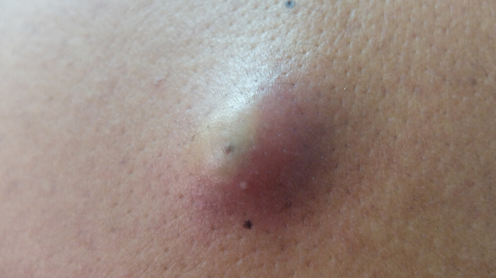 close-up picture of a cyst