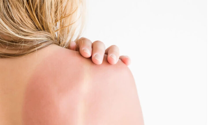 women with sunburn on her back