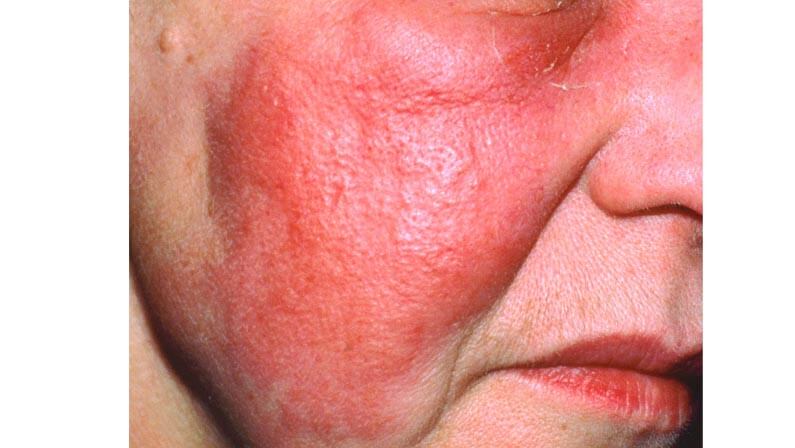 Cellulitis on face