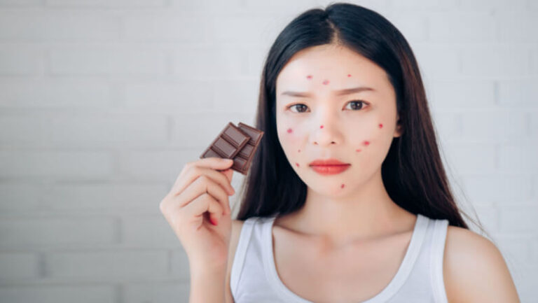 food affects acne