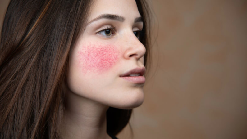 Rosacea