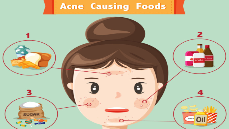 food causing acne