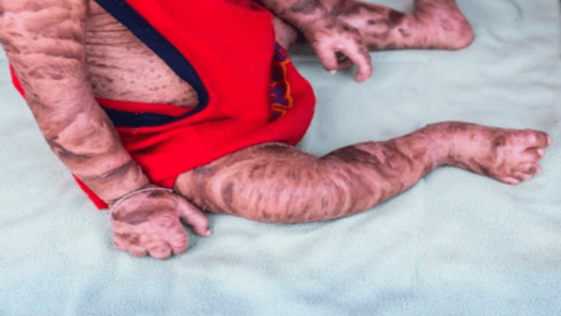 Ichthyosis on a child