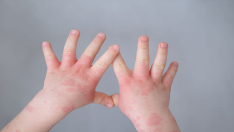 child with eczema