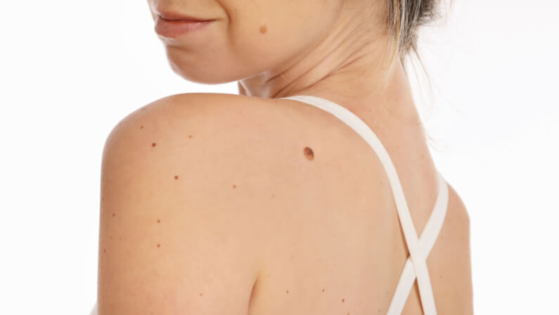 female with skin tags
