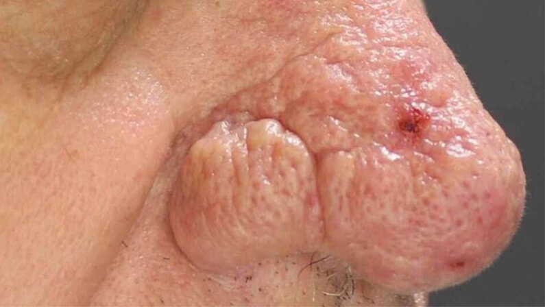 person with Rhinophyma