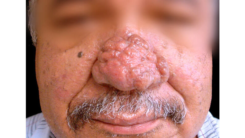 rhinophyma nose