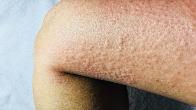 Cold Urticaria on a leg