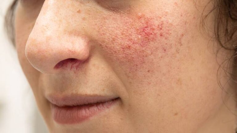 How To Get Rid Of Perioral Dermatitis Team Dermatology 