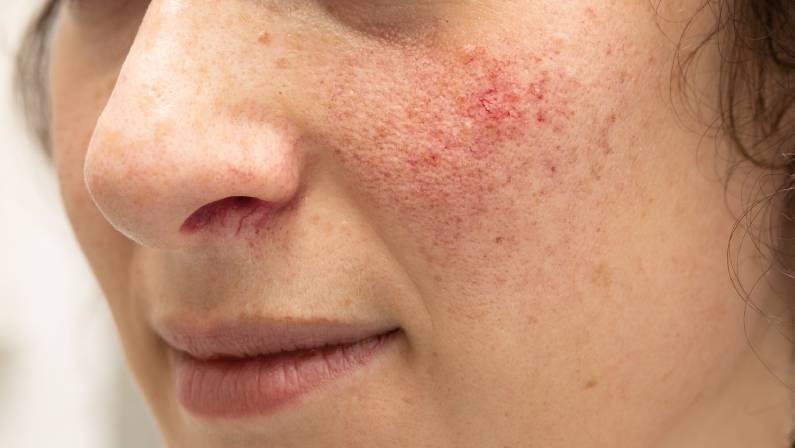 young woman suffering with rosacea on her cheeks and beneath her nose