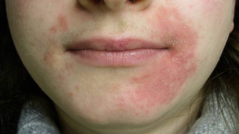 Perioral dermatitis - skin disease on the face