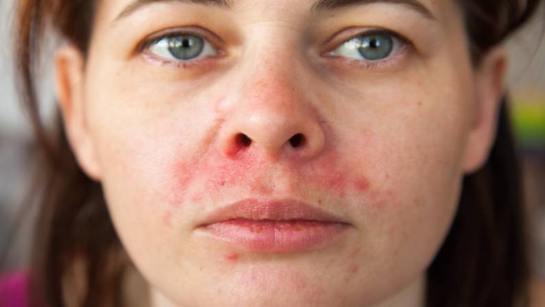 woman's face with perioral dermatitis