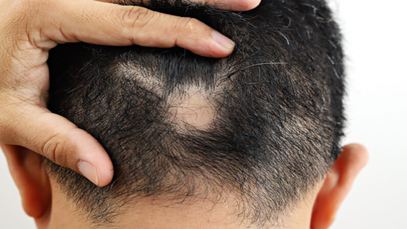 Alopecia areata