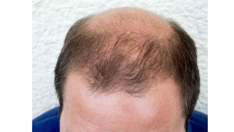 Androgenic alopecia