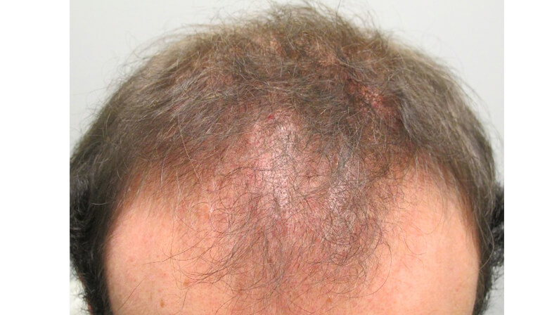 Cicatricial Alopecia