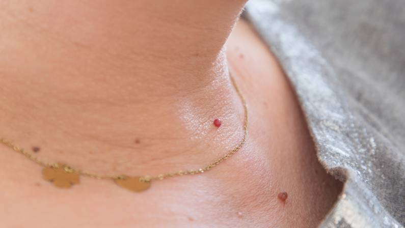 Skin tag on neck