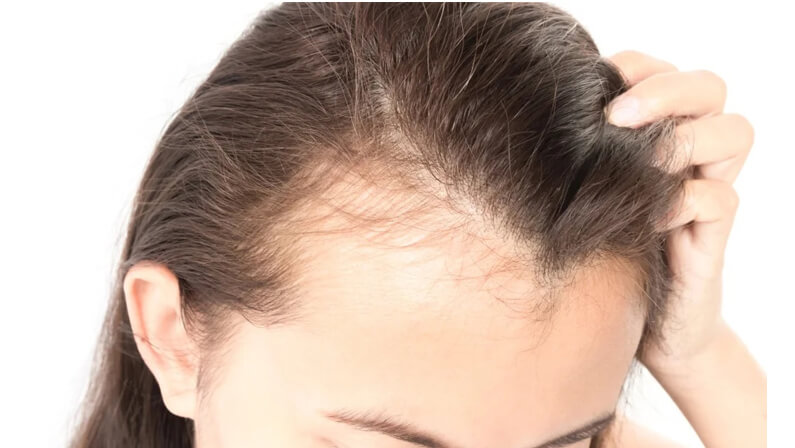 Traction alopecia