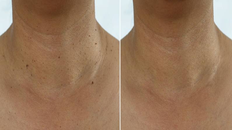 Compare skin tags removal before and after treatment concept