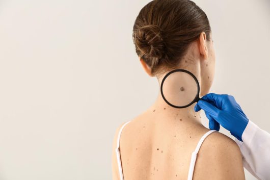 A healthcare professional examines a patient's skin with a magnifying glass, focusing on a mole on the back of the neck. The patient, with dark hair styled in a bun, is wearing a sleeveless top. The image highlights the importance of skin checks for early detection of skin conditions, including melanoma. The professional is wearing blue gloves and a white coat, emphasizing a clinical setting. This visual serves to educate about skin health and the significance of regular dermatological examinations.